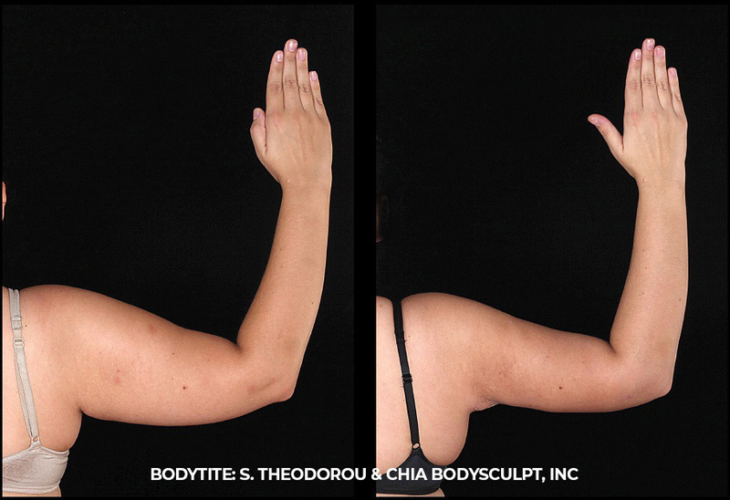 BodyTite & Morpheus: tratamento médico especializado para a flacidez da  pele.